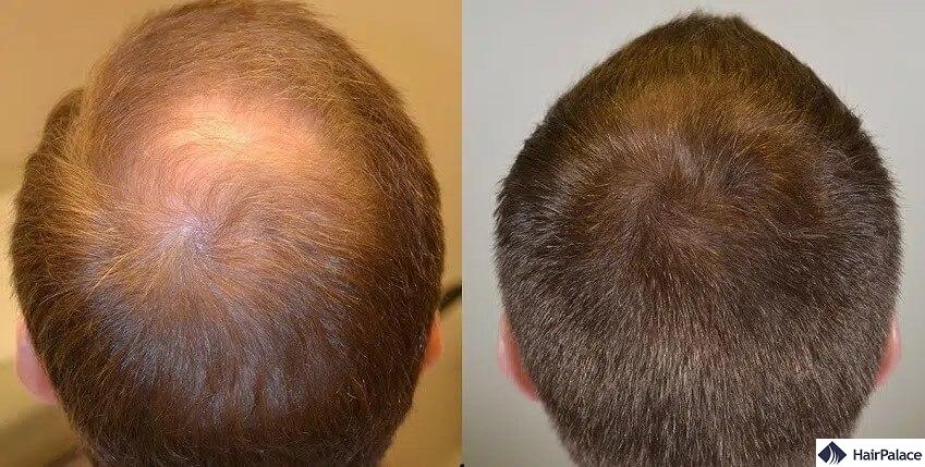 finasteride eredmények