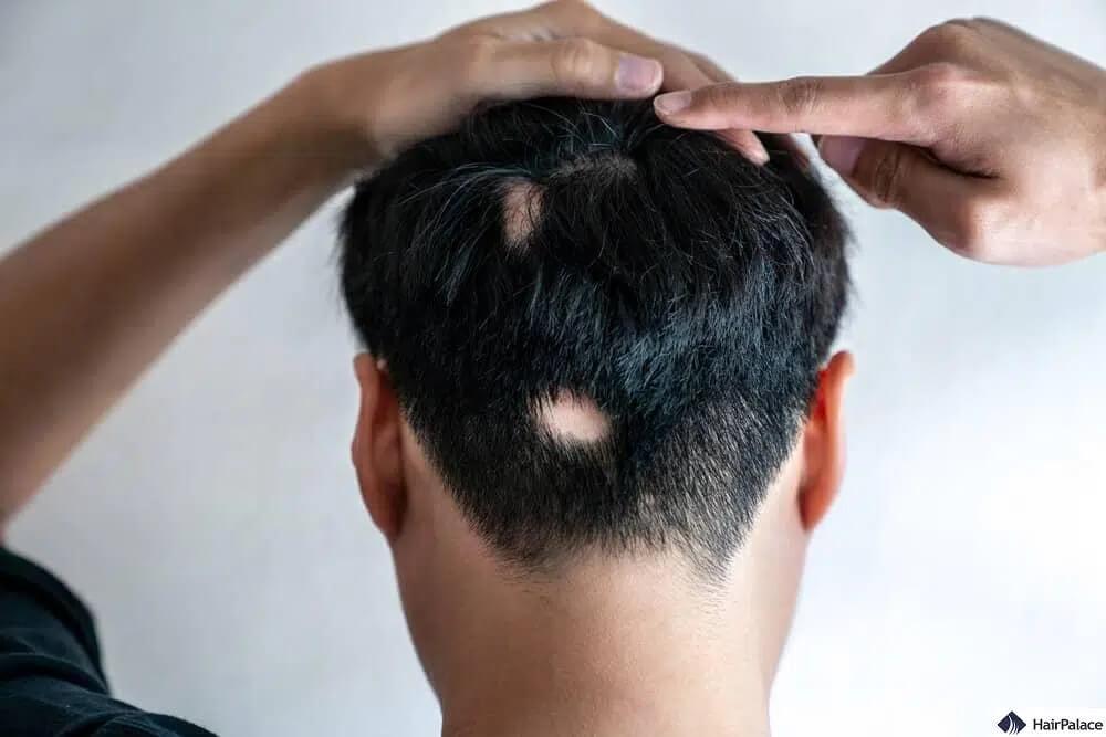 az alopecia areata az egyik leggyakoribb hajhullást előidéző állapot